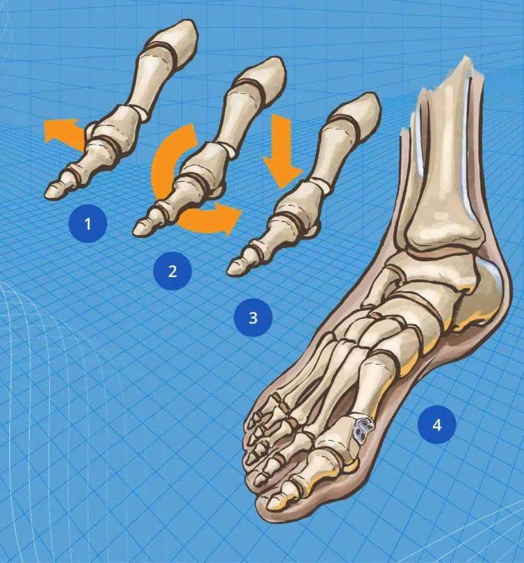 Active Bunion multi-dimensional correction process
