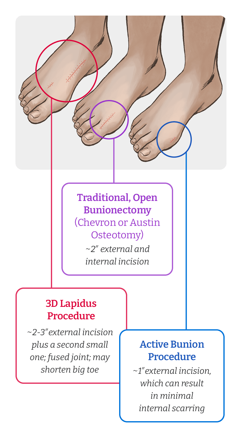 Illustration comparing scars from Active Bunion Procedure (~1