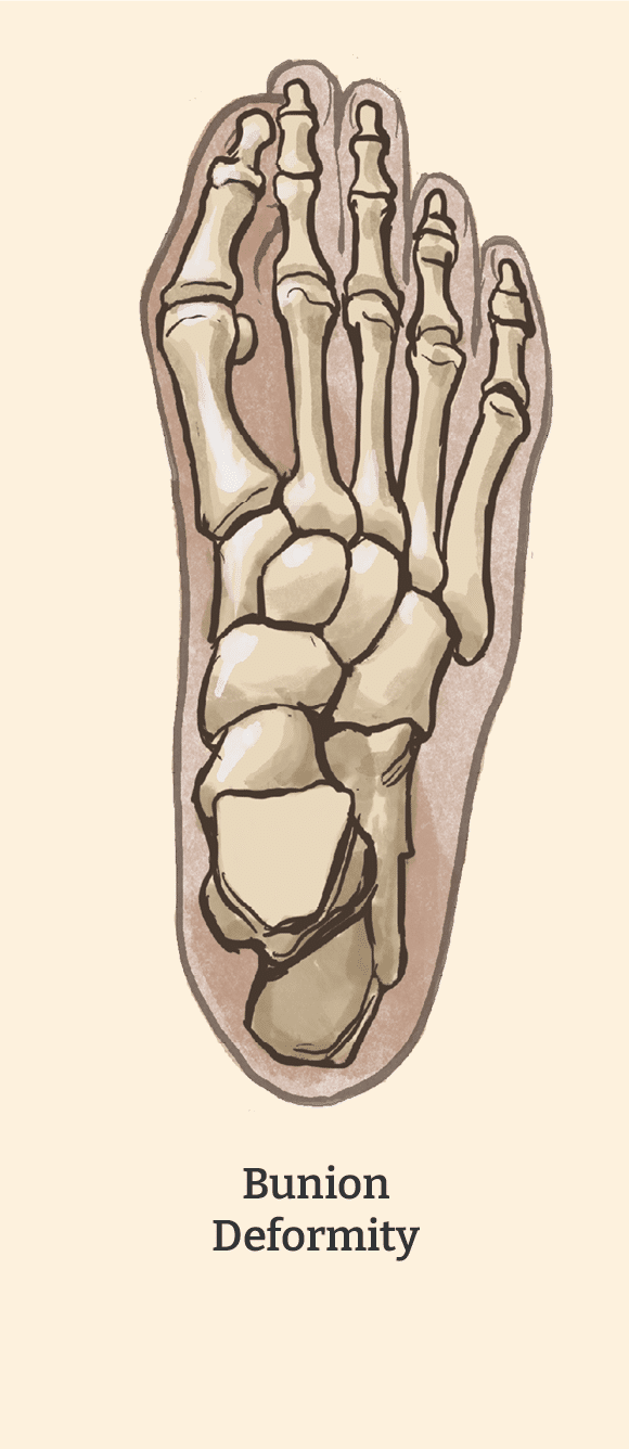 Bunion Deformity