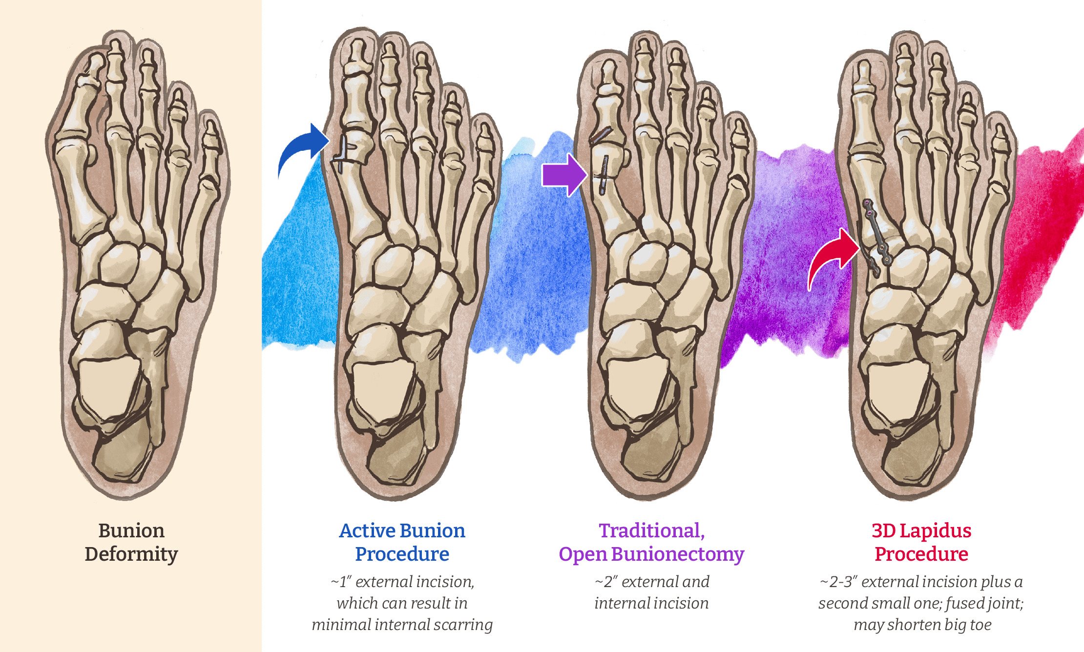 Surgery Comparison Infographic