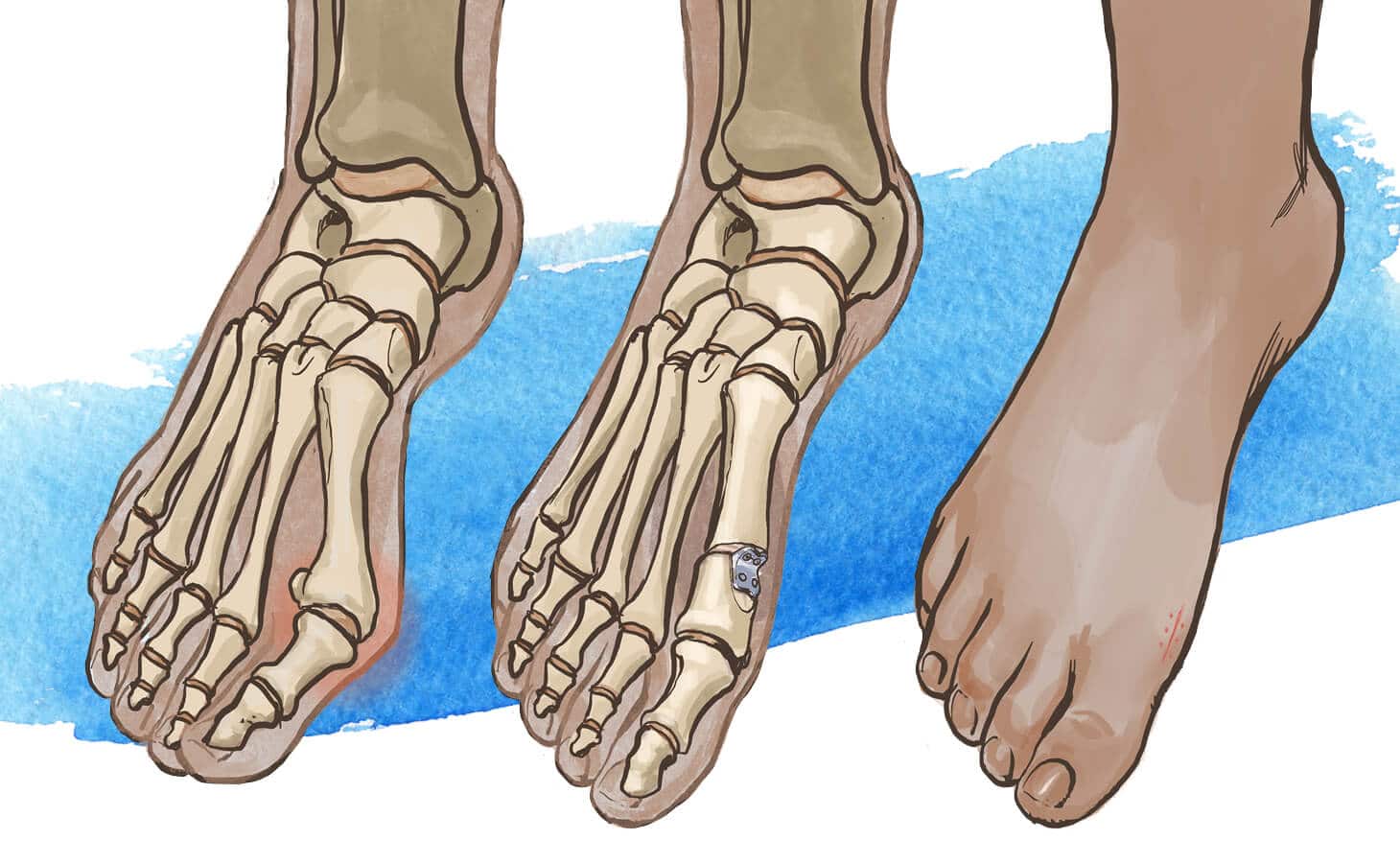Foot illustration.